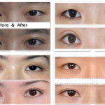 拉双眼皮医院,专业整形，重塑美丽双眸